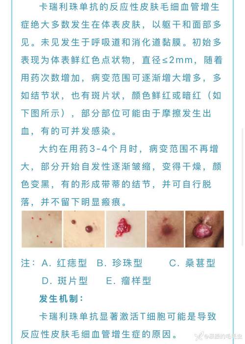 血管瘤是癌症嗎:深入解析良性與惡性的關鍵區別,給您最完整的安心解答 1 血管瘤是癌症嗎
