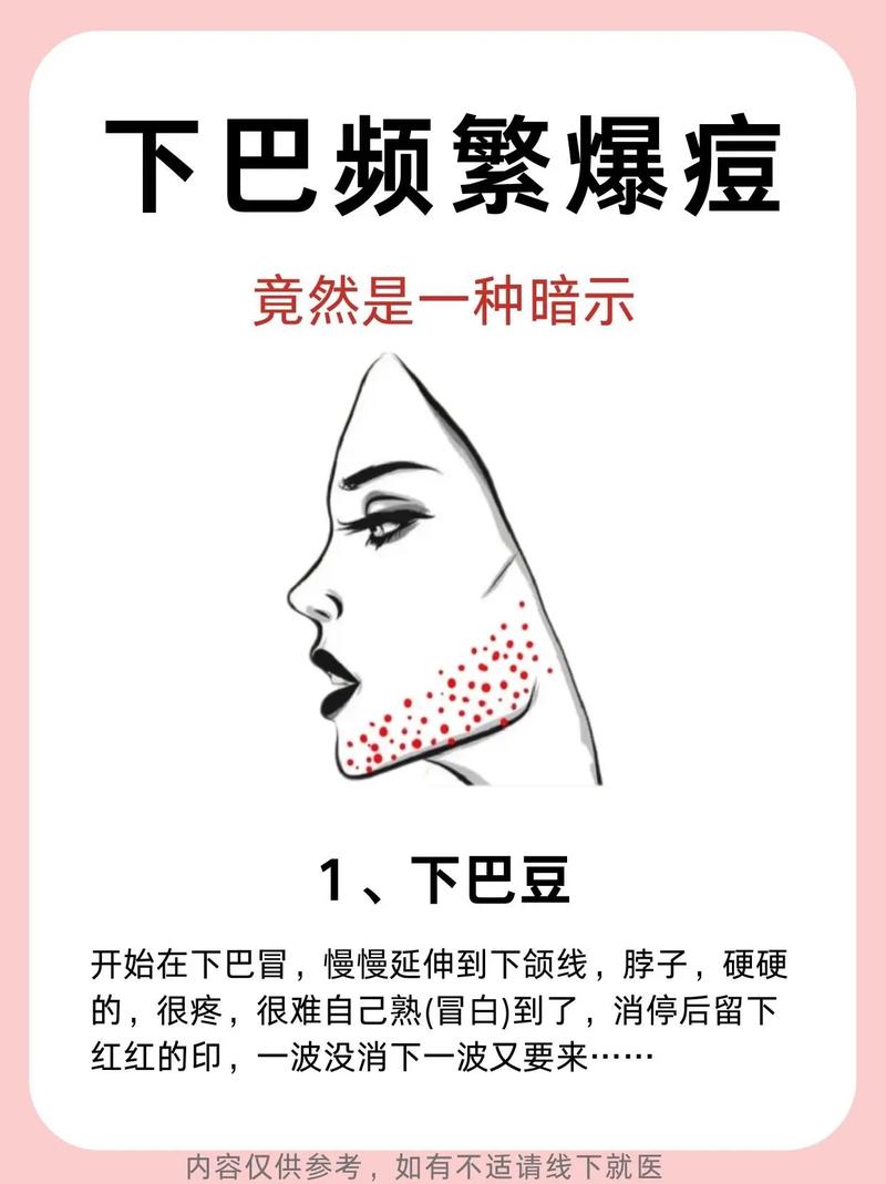 下巴為什麼一直長痘痘