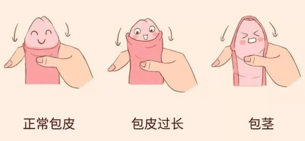 沒割包皮會怎樣嗎:深入解析包皮過長與包莖的健康影響與照護 3 沒割包皮會怎樣嗎