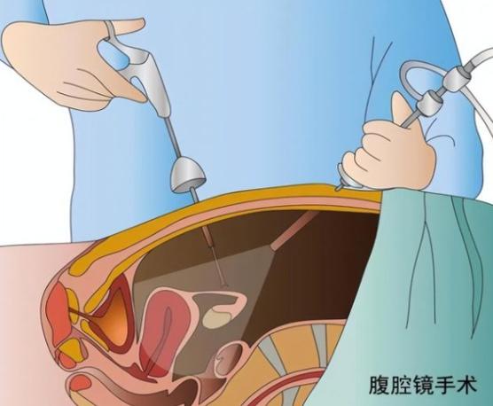 腹腔鏡手術後多久可以運動