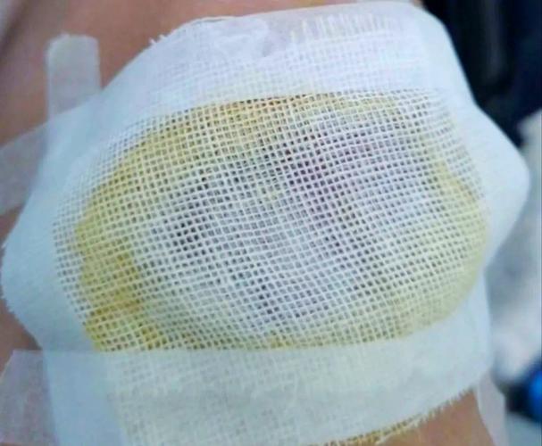 紗布要每天換嗎:傷口照護的黃金準則與常見誤區解析 3 紗布要每天換嗎
