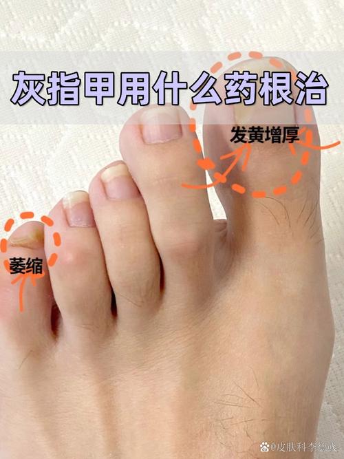 灰指甲可以自己剪嗎:潛在風險、正確護理與專業治療全解析 3 灰指甲可以自己剪嗎