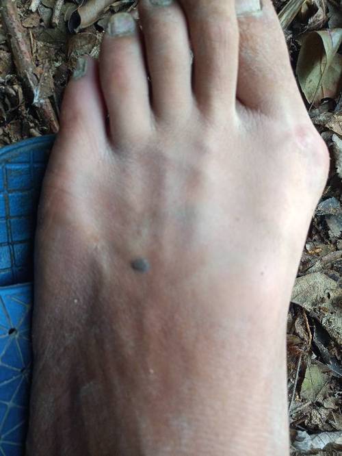 腳背痣