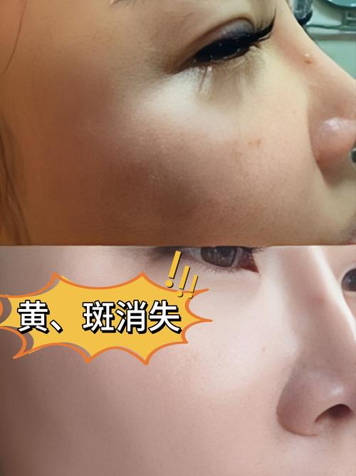 美白針 可以變白嗎