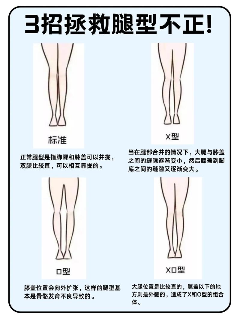 xo型腿是什麼