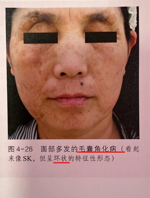 毛孔角化可以雷射嗎?揭秘雷射治療的原理、種類與注意事項,告別雞皮膚! 1 毛孔角化可以雷射嗎