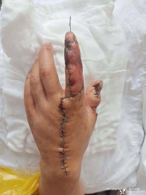 壓傷多久會形成