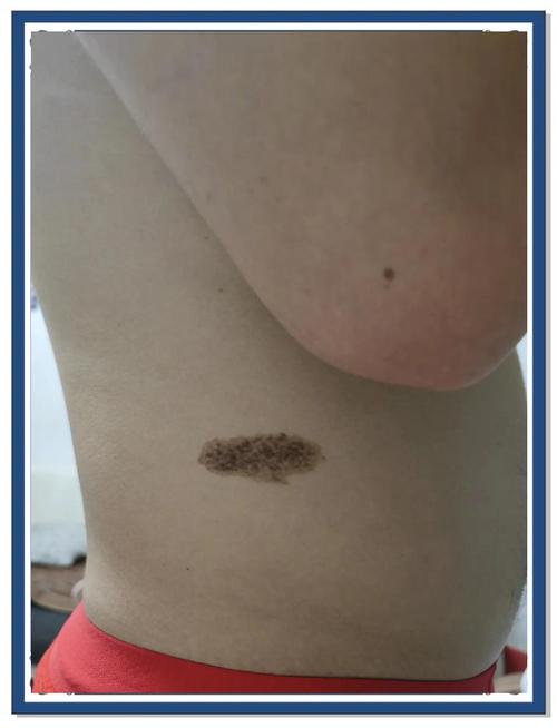 為什麼人會有胎記