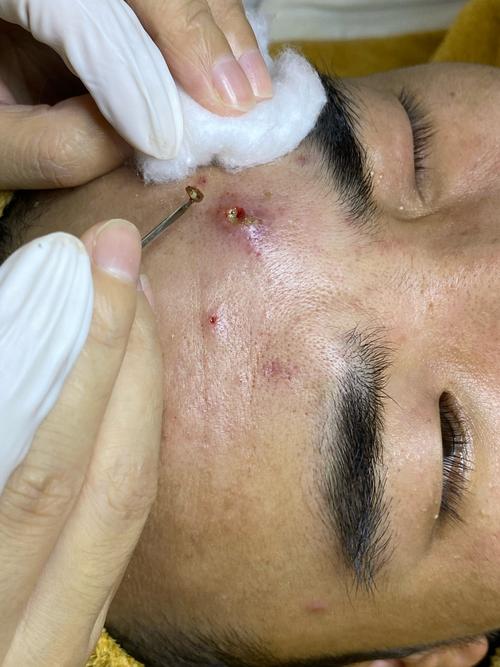 囊腫型痘痘怎麼消徹底根除深層發炎與預防復發的完整指南 3 囊腫型痘痘怎麼消