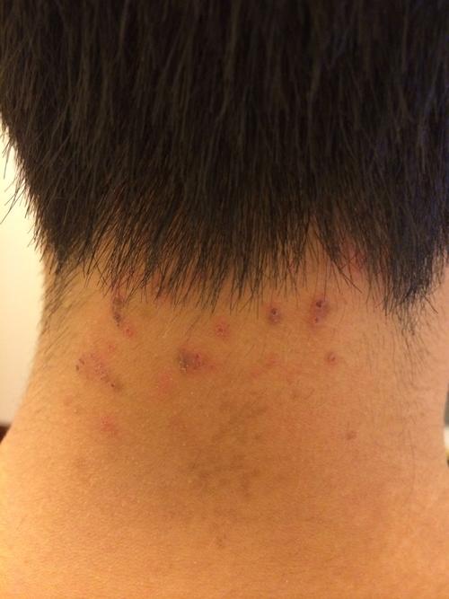 脖子後面長痘痘