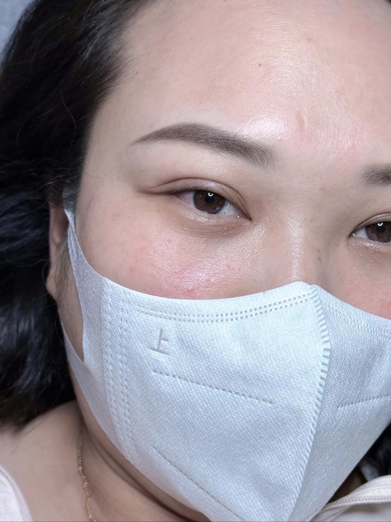 霧眉紅腫怎麼辦