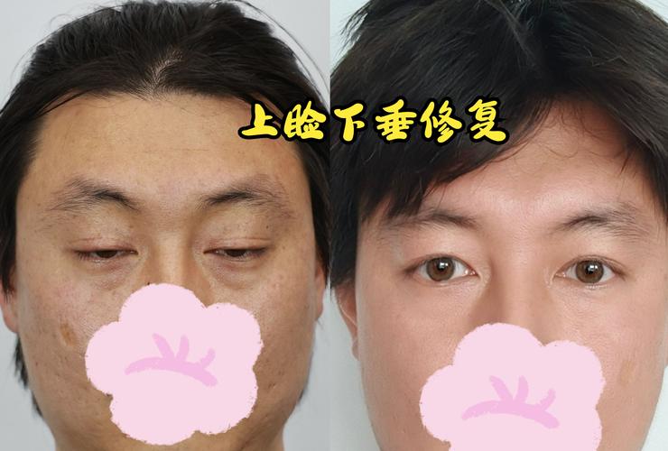 眼皮下垂怎麼改善