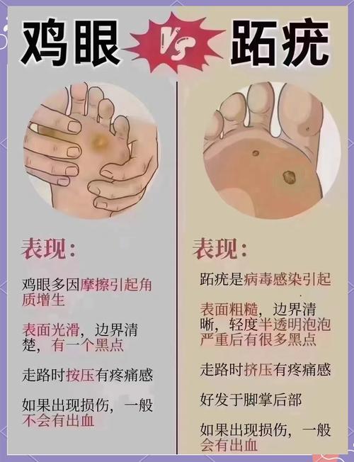 雞眼 看什麼科:深度解析、診斷與治療權威指南 3 雞眼 看什麼科