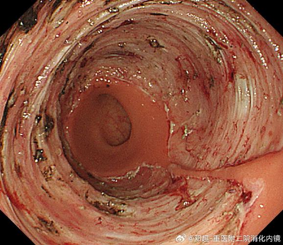 沒有直腸會怎樣