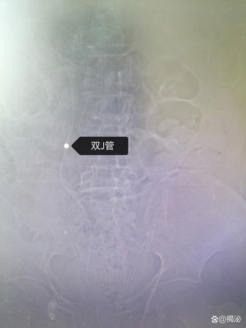 輸尿管結石手術後