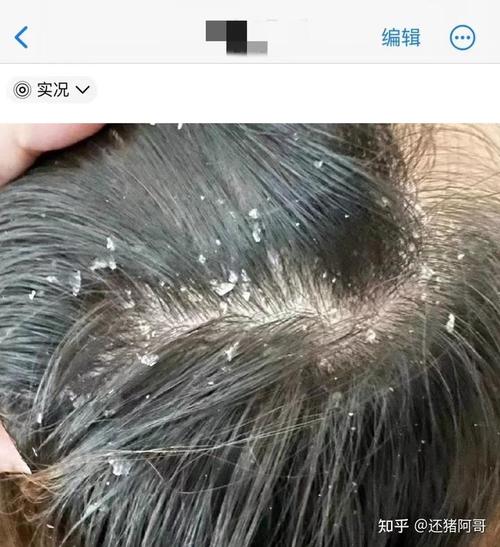 一直摳頭皮會掉髮嗎:深入探討頭皮搔抓與掉髮的關聯 1 一直摳頭皮會掉髮嗎