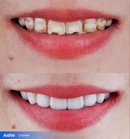 牙齒是什麼顏色