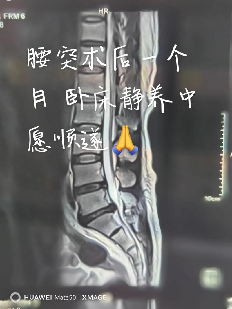 腰椎手術後多久可以工作