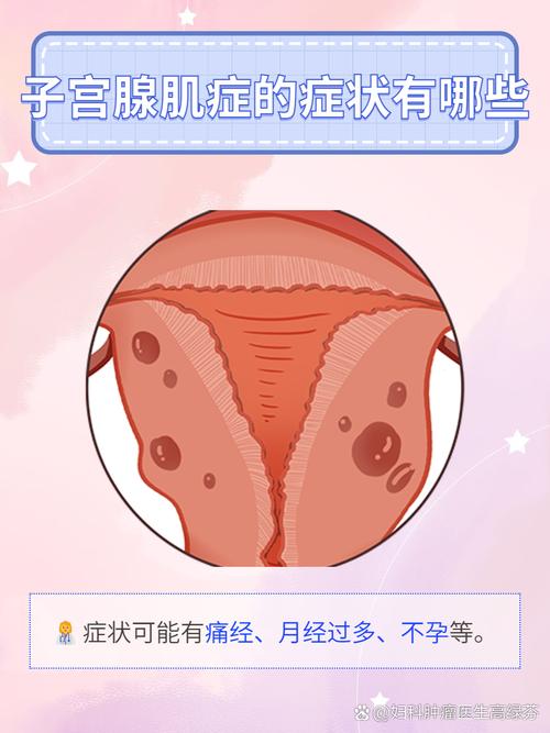 子宮肌腺症一定要拿子宮嗎