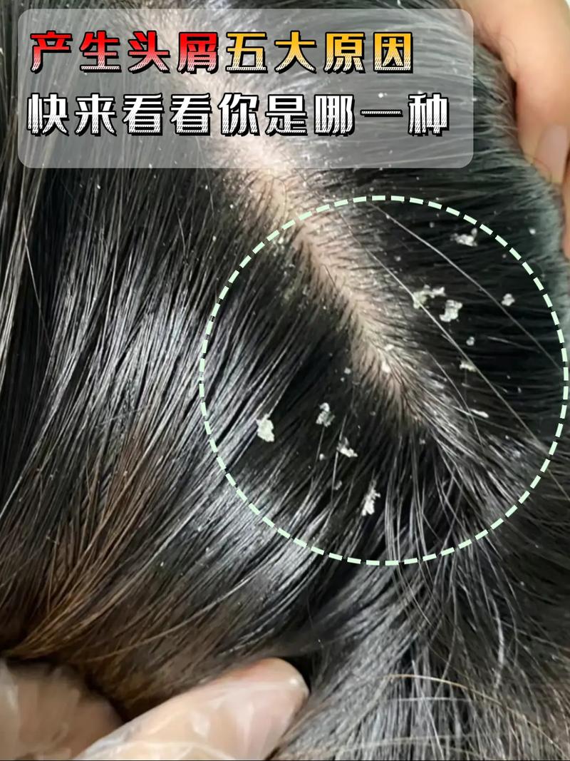 為什麼染完頭髮會有頭皮屑