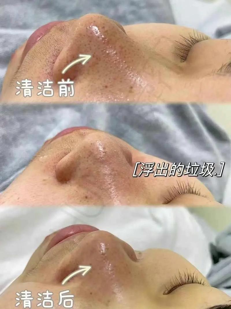 粉刺如何清