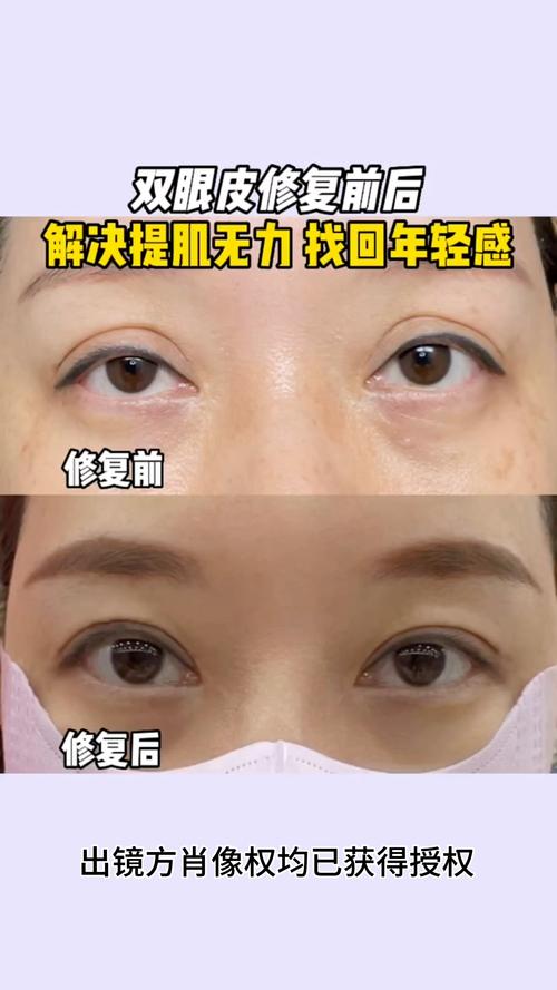 提眼瞼肌眼睛會變大嗎
