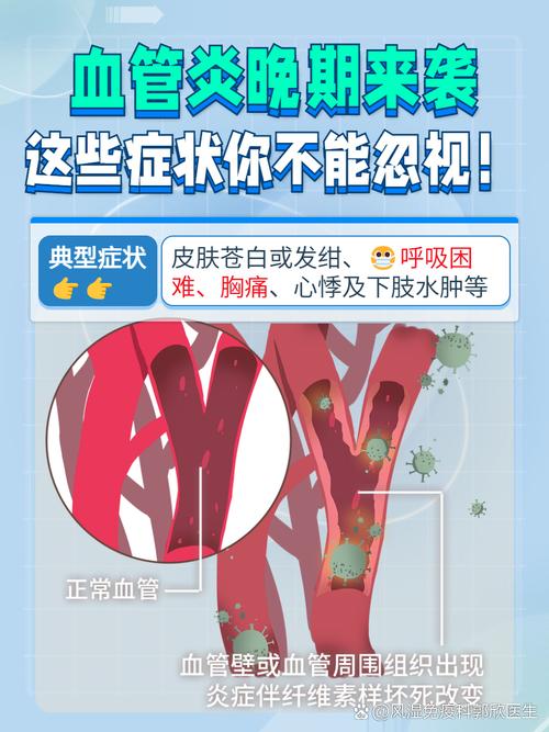 為何會得血管炎