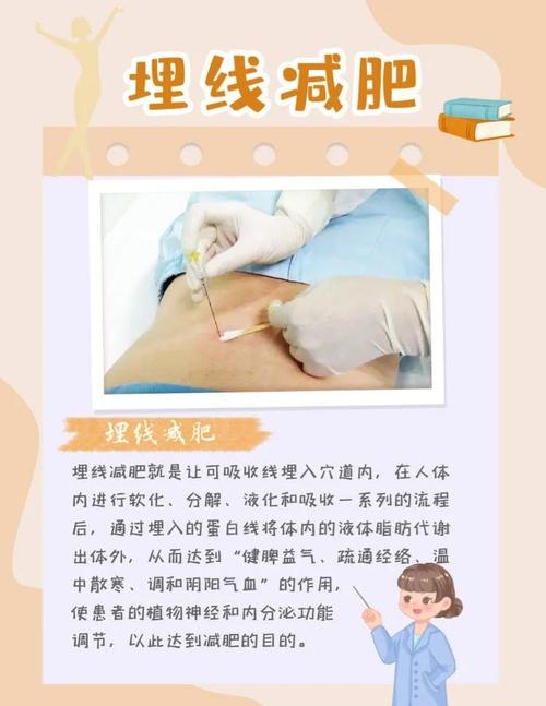 為什麼埋線會瘦