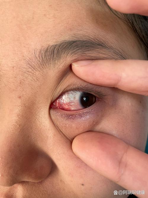 眼睛有異物感