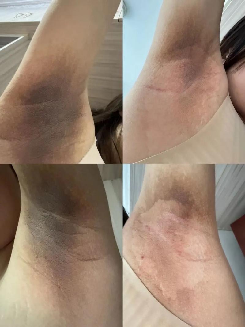 懷孕腋下變黑會恢復嗎