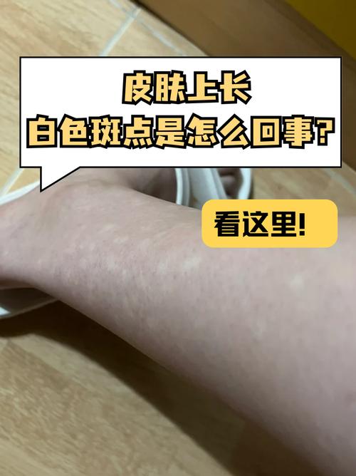 怎麼叫出小白點?深度解析粟粒腫成因、專業去除與日常預防,讓肌膚重現光滑透亮! 1 怎麼叫出小白點