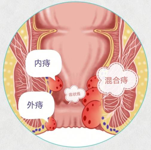 女生會得痔瘡嗎