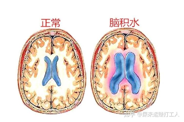 腦積水會死嗎