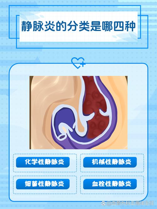 靜脈炎多久會好?從成因、症狀到完整照護與預防,深度解析康復時間 1 靜脈炎多久會好