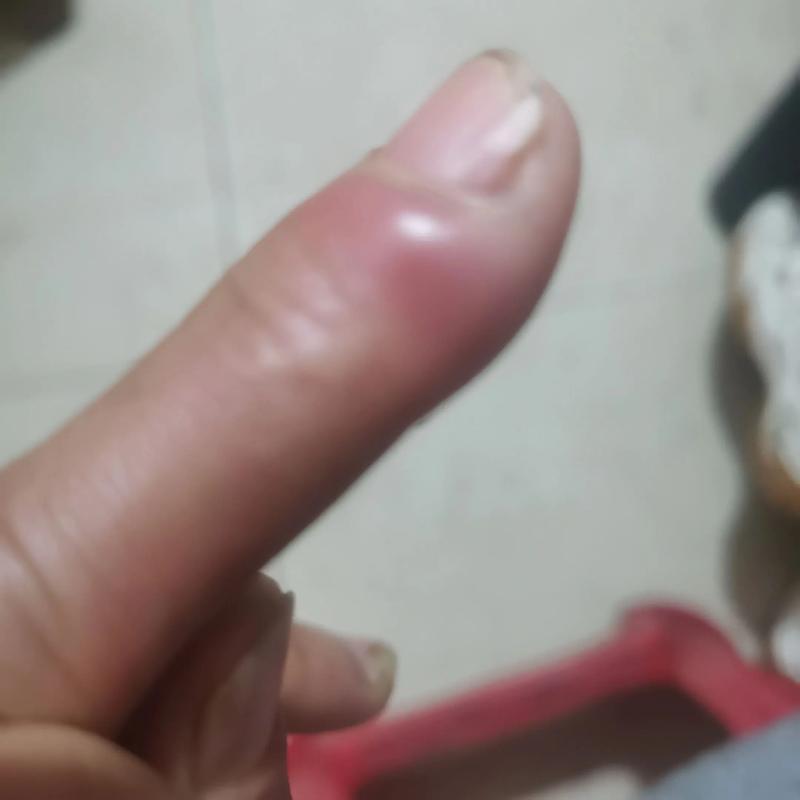 打排球打到手腫起來怎麼辦