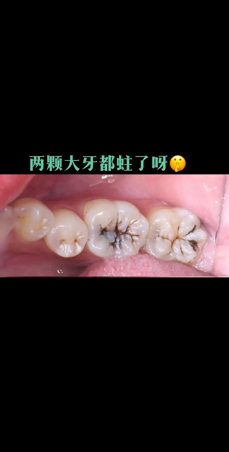 為什麼蛀牙會黑