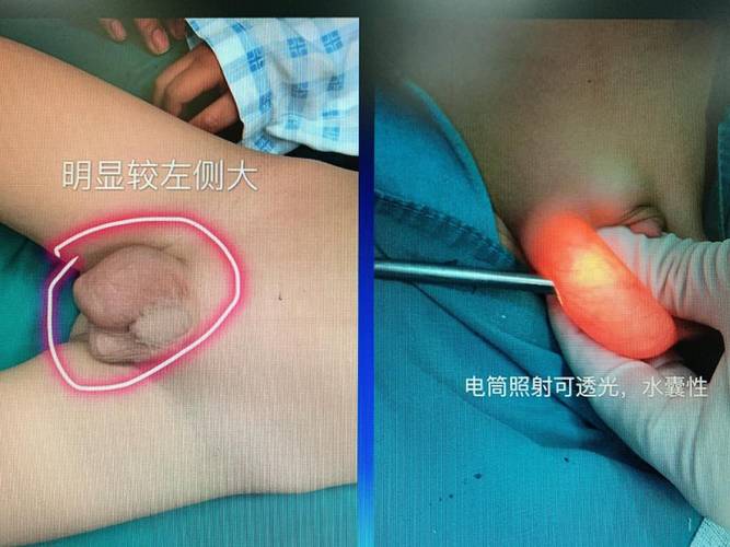 男生為什麼會疝氣