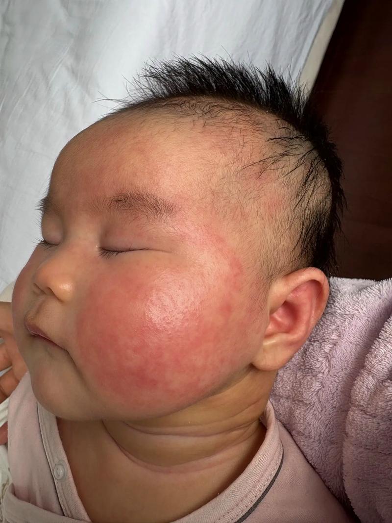 濕疹可以擦馬油嗎