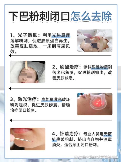 閉鎖粉刺怎麼清