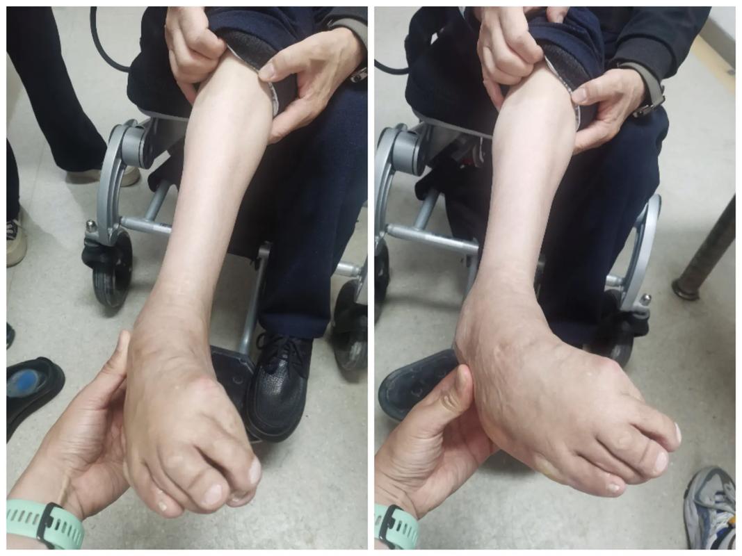 小兒麻痺是先天嗎