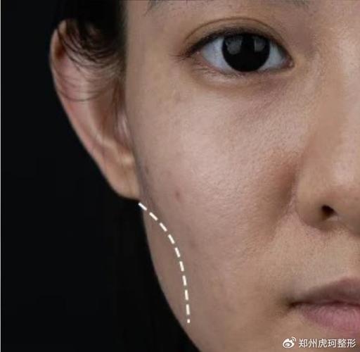 臉凹打什麼