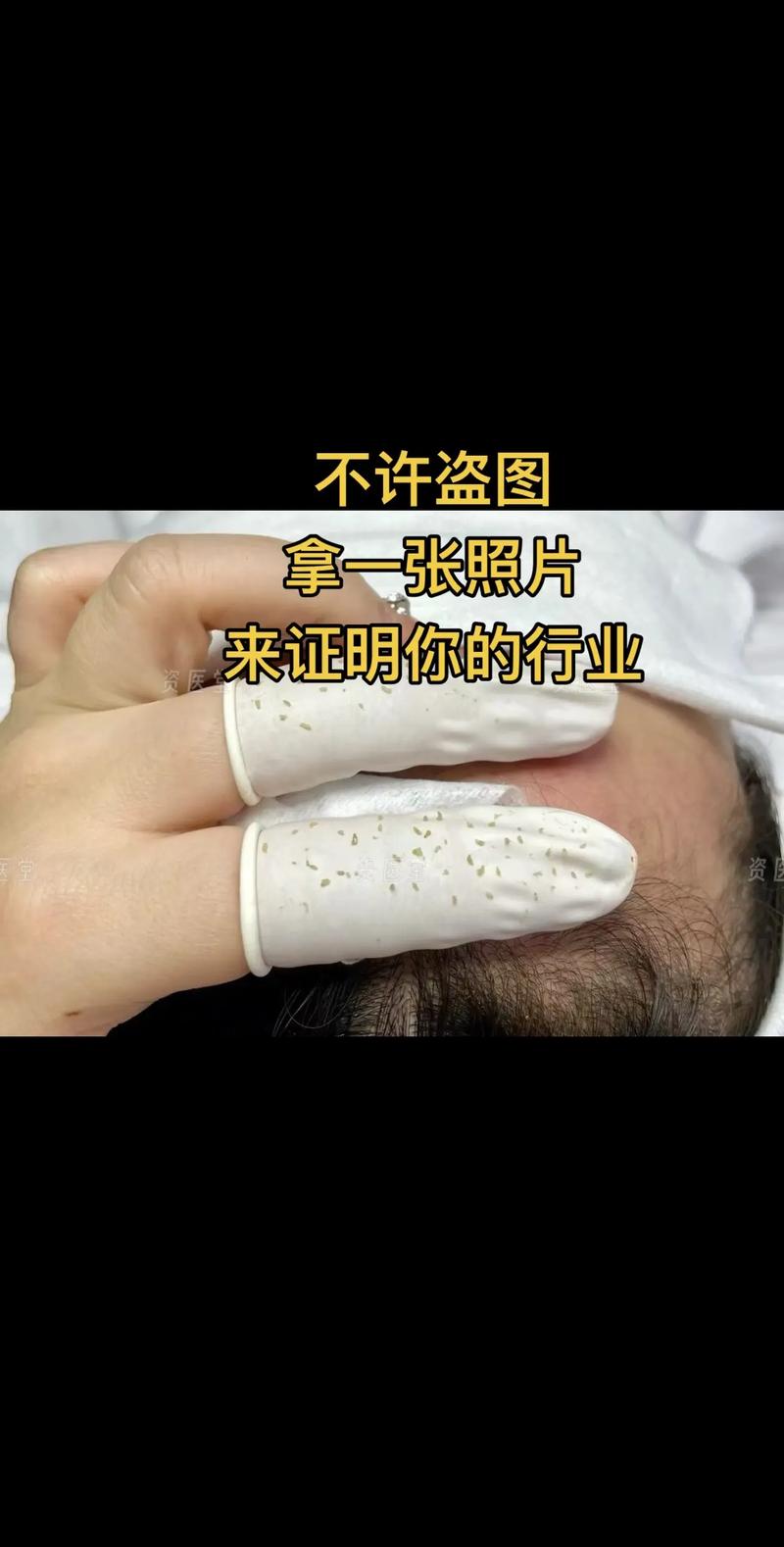 可以自己清粉刺嗎