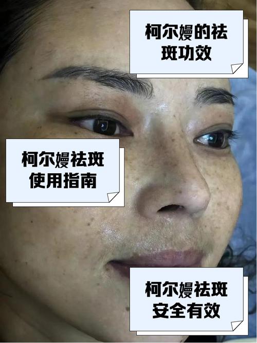 柯氏斑點是什麼