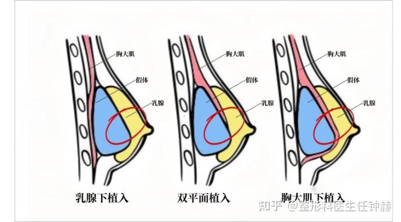 隆乳可以揉嗎