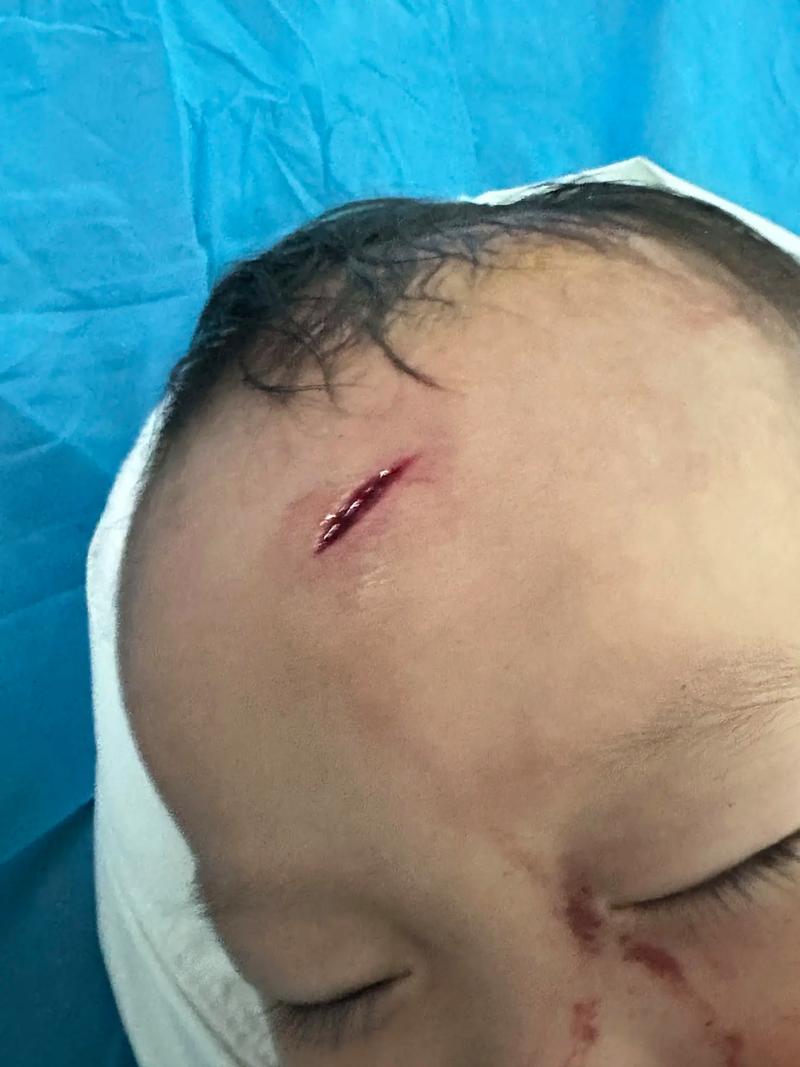 頭縫針多久可以洗頭
