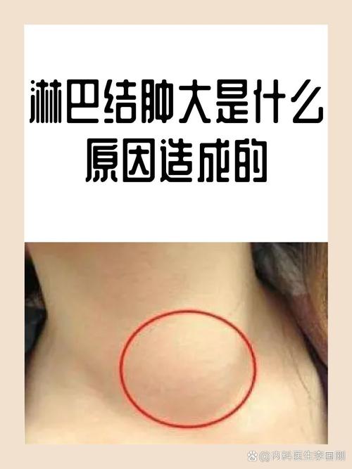 淋巴腫大會自己消嗎