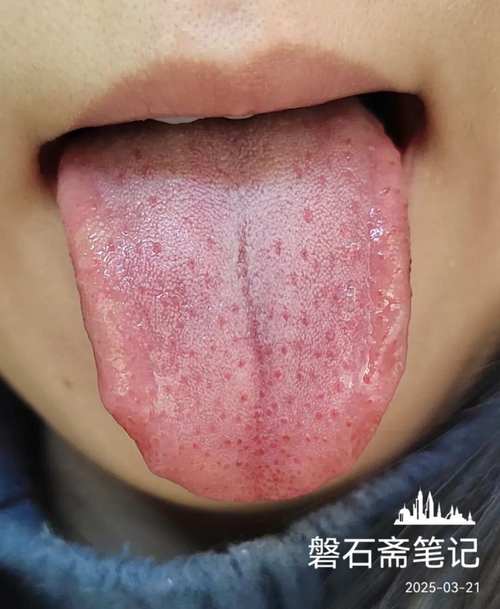 草莓舌