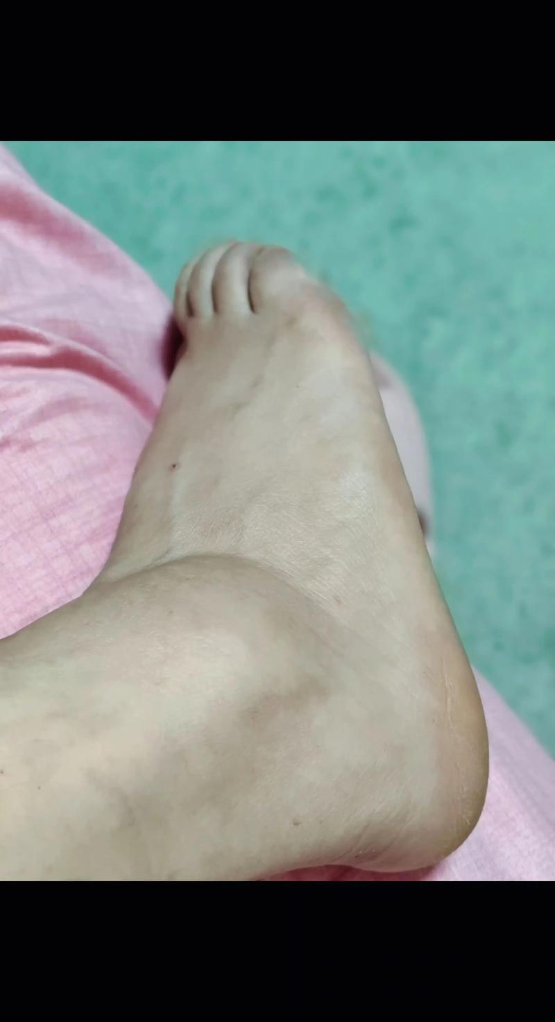 拉傷會腫起來嗎