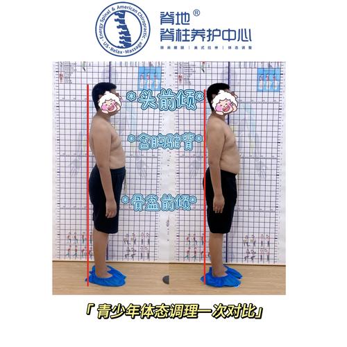 嬰兒會駝背嗎