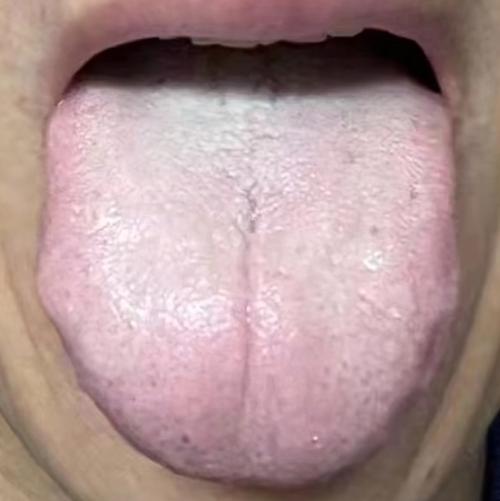 為什麼舌苔很厚?深入解析成因、影響與根治之道,還你清新好口氣! 1 為什麼舌苔很厚